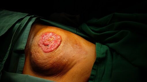 Maladie de Paget du mamelon | Photos, Symptômes et Traitements