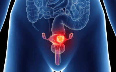 Cancer des ovaires: Symptômes, Diagnostic et Traitements